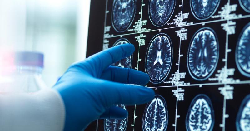 Перші прояви деменції: фахівець виділив п’ять небезпечних ознак, на які слід звертати увагу.